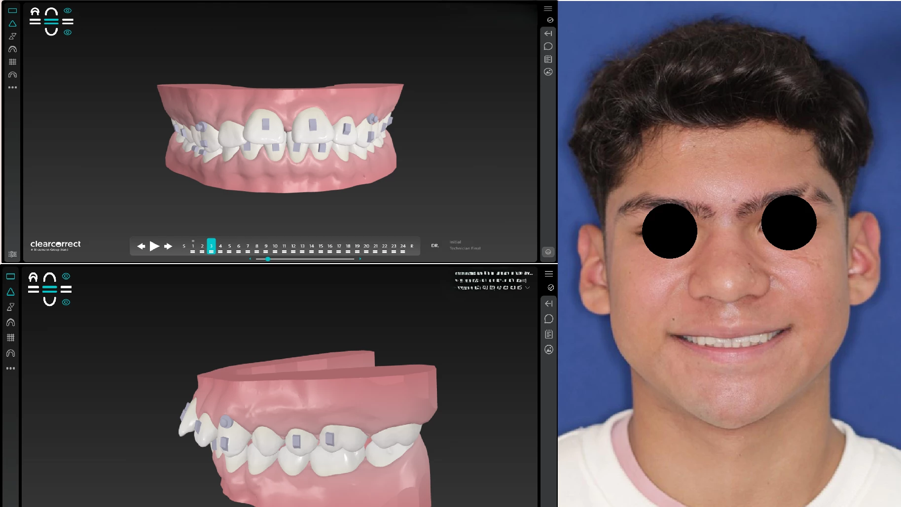 Planeación digital del tratamiento de alineadores